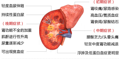 肾炎、肾功能不全、肾衰竭、尿毒症4个阶段,看看你属于哪个阶段!
