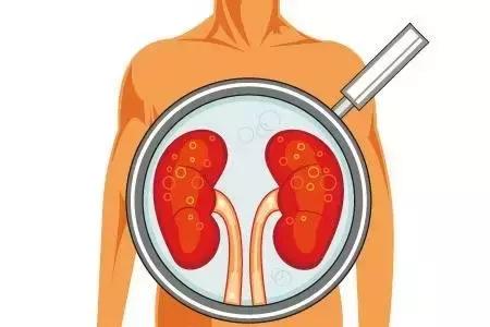 肾病患者出现这五大症状是,可以判断为肾病综合征!