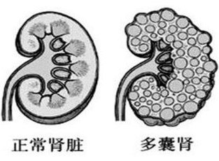 肾囊肿和多囊肾是一种疾病吗?多囊肾是怎么回事?